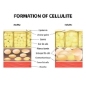 Anticeluliten-masazor-Celluless-MD-don_100028